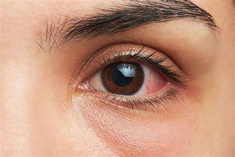 5 Common Types Of Eye Infections Wethinkhealthonline