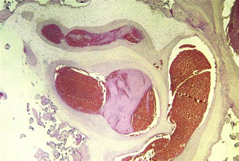 Fetal Thrombotic Vasculopathy Surgical Pathology Clinics