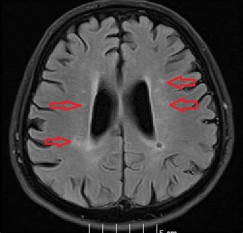 Right Ventricular Infarction