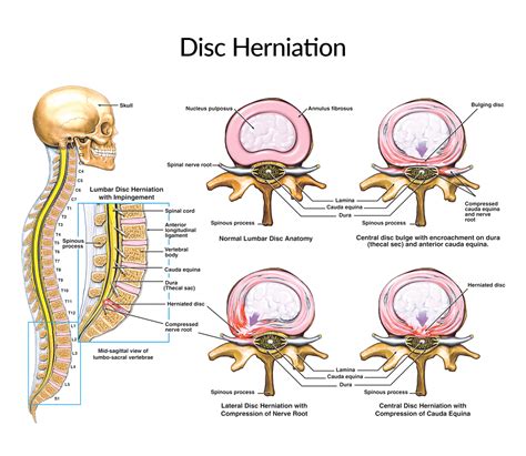 Herniated Disc Q & A - Nkrumah Neurosurgery