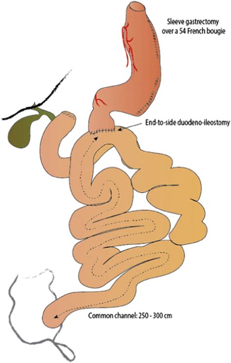 Schematic Representation Of The Single Anastomosis Duodeno Ileal Bypass