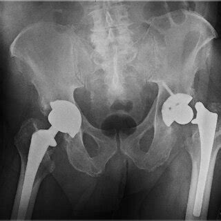 The Preoperative Anteroposterior Radiograph Showing Our Patient With