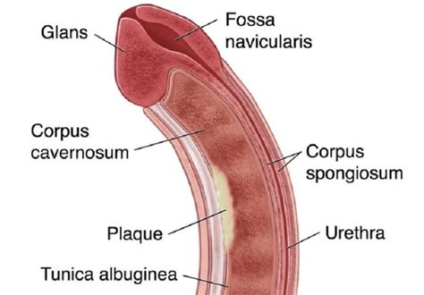 Novel Treatment For Strictures Of The Distal Penile Urethra And Fossa