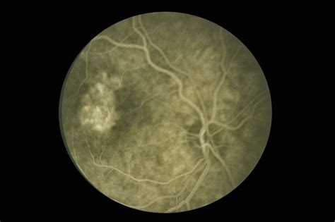 Presumed Ocular Histoplasmosis Syndrome Retina Image Bank