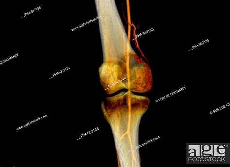 3D Computed Tomography CT Scan Of The Knee Showing The Vascularization