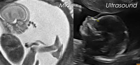 Mri Vs Ultrasound