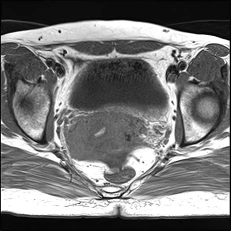 Uterine Arteriovenous Malformation Image