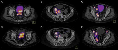 Comparison Between 68 Ga HBED CC PSMA PET CT And 99m Tc Hynic IPSMA