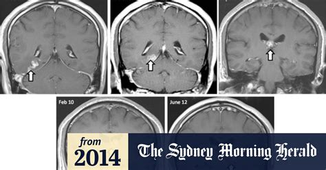 Doctors Remove Tapeworm From Man S Brain After Four Years