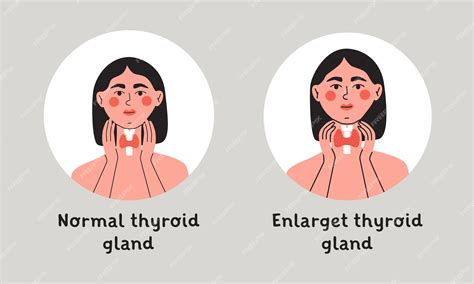 Normal Thyroid