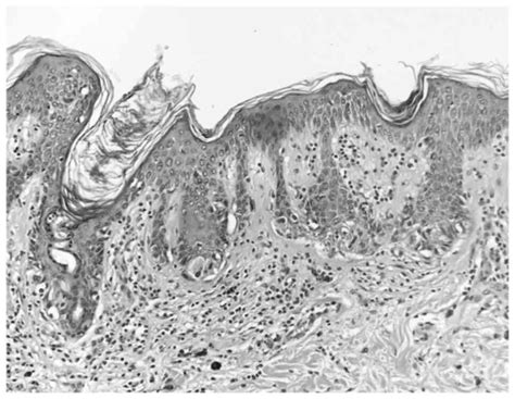 Dysplastic Nevus Histology