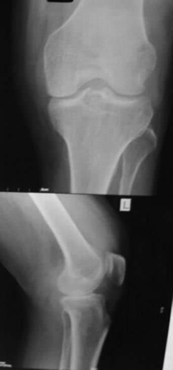 X Ray Of The Knee Joint Showing Juxta Articular Intraosseous Cyst A