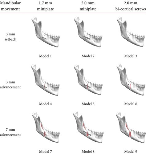 Models With Respective Fixation Technique And Mandibular Movements