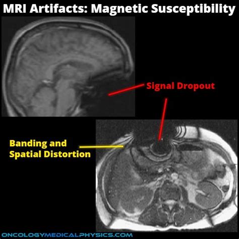 Mri Artifacts Oncology Medical Physics