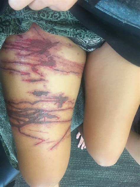 Box Jellyfish Sting Marine Bites And Stings: First Aid And Medical