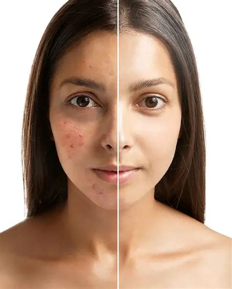 LAS MANCHAS DE ACNE Y SU TRATAMIENTO NIVEA