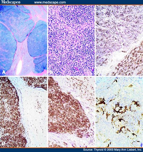 Pathology Outlines Thymic Tissue