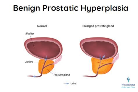 Benign Prostatic Hyperplasia Dubai Uae Westminster Ortho Med