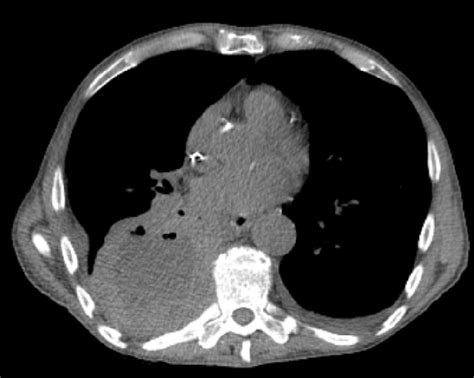 Figure 1 From Bronchogenic Squamous Cell Carcinoma Mass With Central