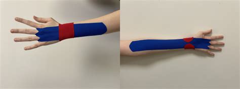 Comparison Of The Effectiveness Of 2 Different Kinesio Taping