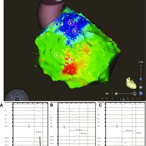 Epicardial Activation Mapping Of The Right Ventricle A Normal RV