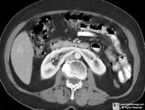 Procedures- Pathology Blog: Horseshoe Kidney