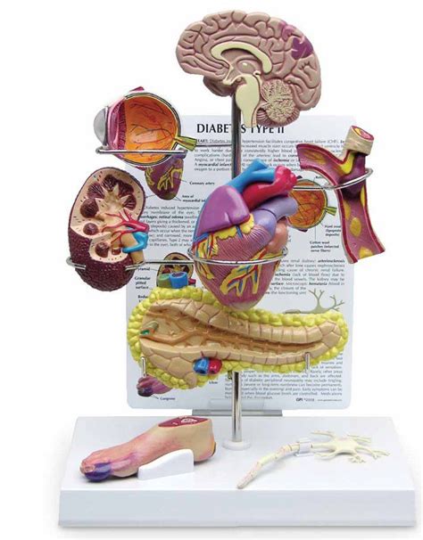 Anatomisches Modell Zur Sensibilisierung F R Diabetes Sb