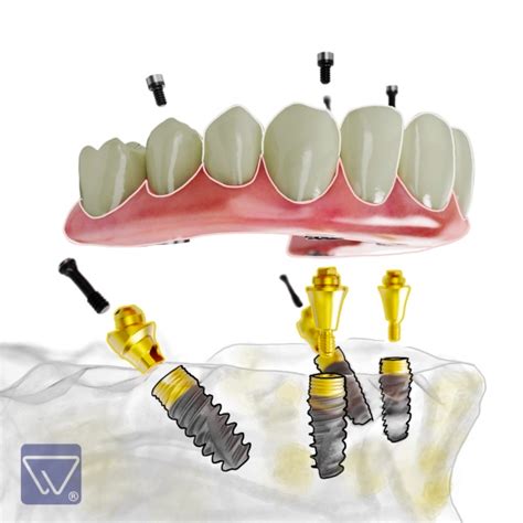 Dinti Ficsi In 24 Ore Dantura Fixa Cu Implant Dentar