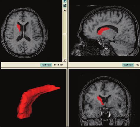 Views Of The Traced Caudate Nucleus And 3d Reconstruction Images From