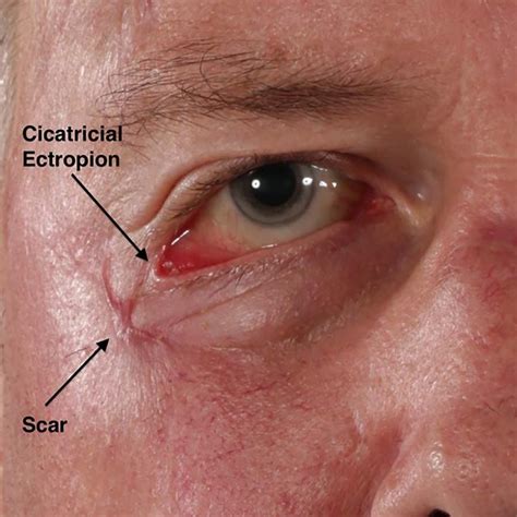 Pdf Cicatricial Ectropion After Wound Closure Of Facial Laceration