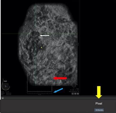 Frontiers Evaluation Of A New Method Of Calculating Breast Tumor