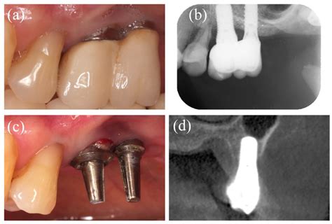 Baseline Presentation In Case 1 A Intraoral View Of The Maxillary