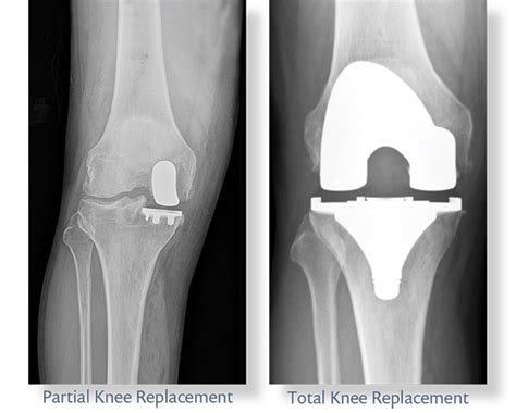 Unicompartmental Partial Knee Replacement Surgery Perth