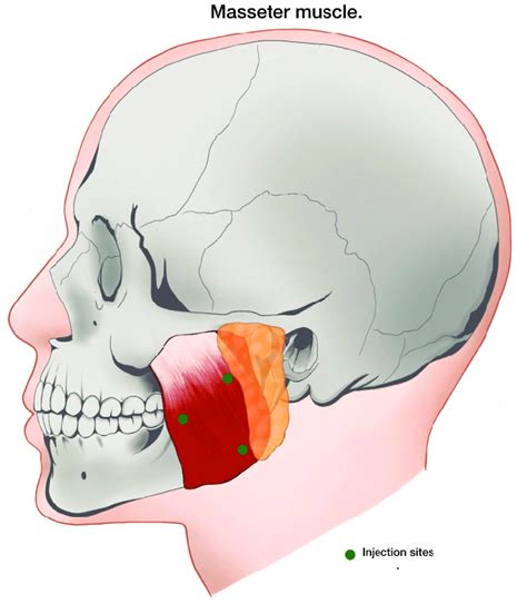 Masseter Muscle Recommended Injection Sites Download Scientific Diagram