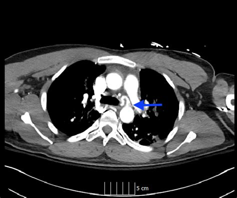 What Is the Source of This Man’s Hemoptysis? | Consultant360