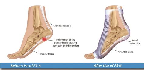 Plantar Fasciitis The Foot And Ankle Clinic