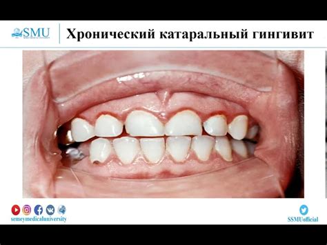 Гингивит: классификация, симптомы, группы риска, профилактика