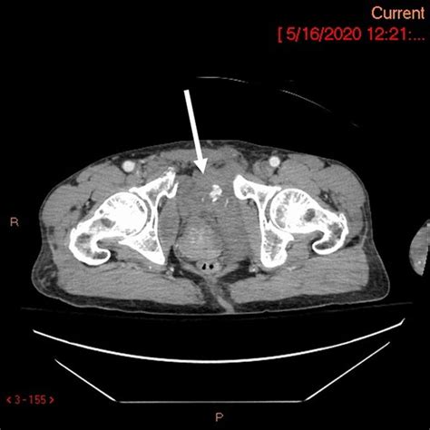 Pelvic Fracture With Widened Pubic Symphysis Hematoma And