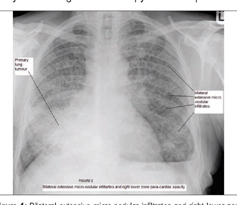 Figure 1 From Bilateral Miliary Shadowing On Chest X Ray Semantic