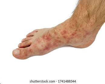 Close Males Foot Toes Red Rash Stock Photo 1745792516 Shutterstock