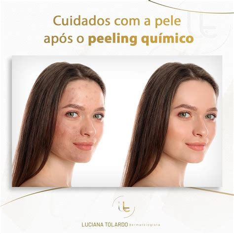 Cuidados Com A Pele Após O Peeling Químico Dra Luciana Tolardo