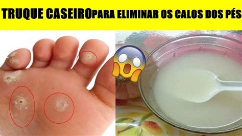 Como Remover Calosidades Dos Pés BRAINCP