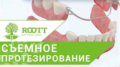 Виды съемных зубных протезов. 👵 Различные способы крепления и виды ...