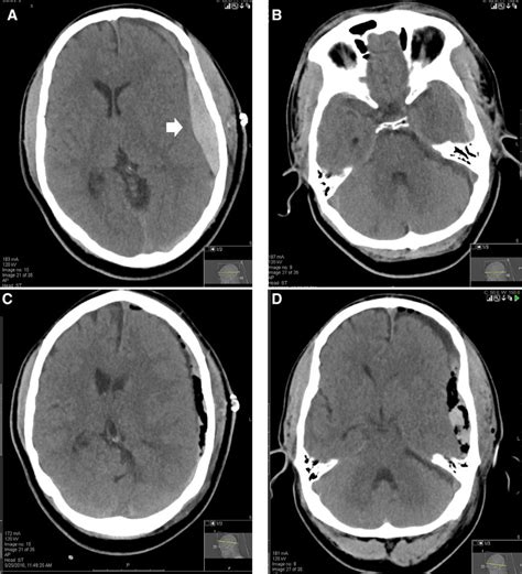 Axial brain CT scan subdural window. (A) and (B) performed after the ...