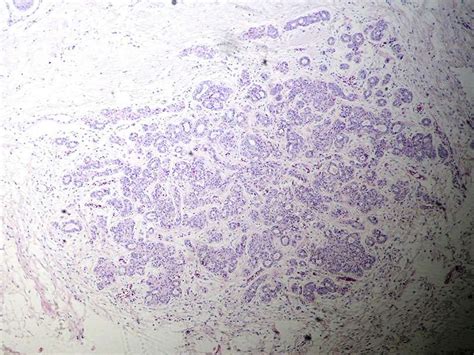 Sclerosing And Apocrine Adenosis With Atypia Bosnianpathology