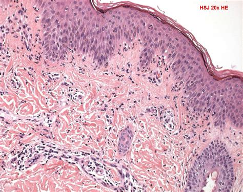 Linear Iga Bullous Dermatosis Humpath Human Pathology Photos