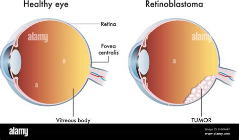 Linfoma Oculare Immagini E Fotografie Stock Ad Alta Risoluzione Alamy