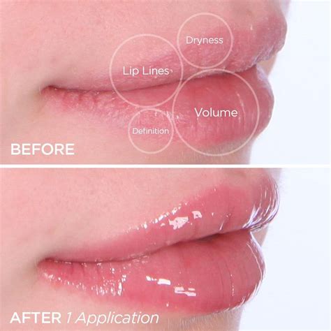 Lip Filler London Artofit