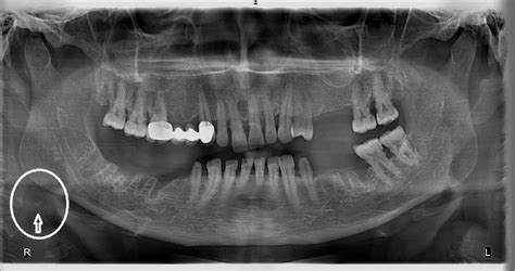 A Panoramic Radiograph Of A Year Old Female There Was Unilateral