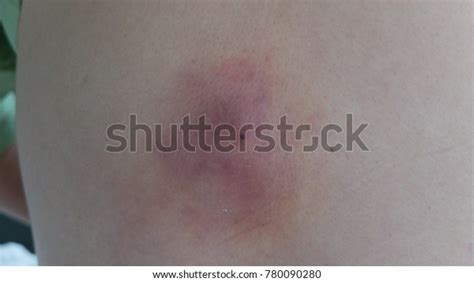 Infected Sebaceous Cyst Complicated Abscess Formation Stock Photo